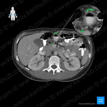 Vena gastroomentalis dextra (Rechte Magen-Netz-Vene); Bild: 