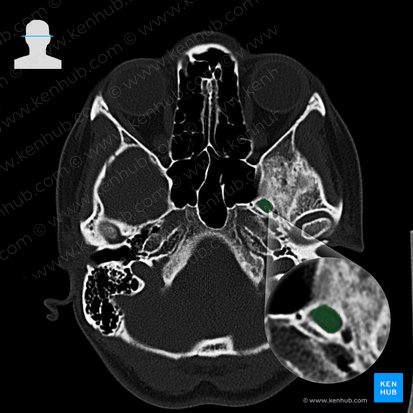 Foramen ovale; Image: 