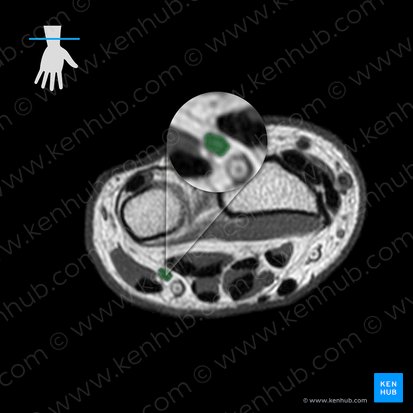 Ulnar nerve (Nervus ulnaris); Image: 