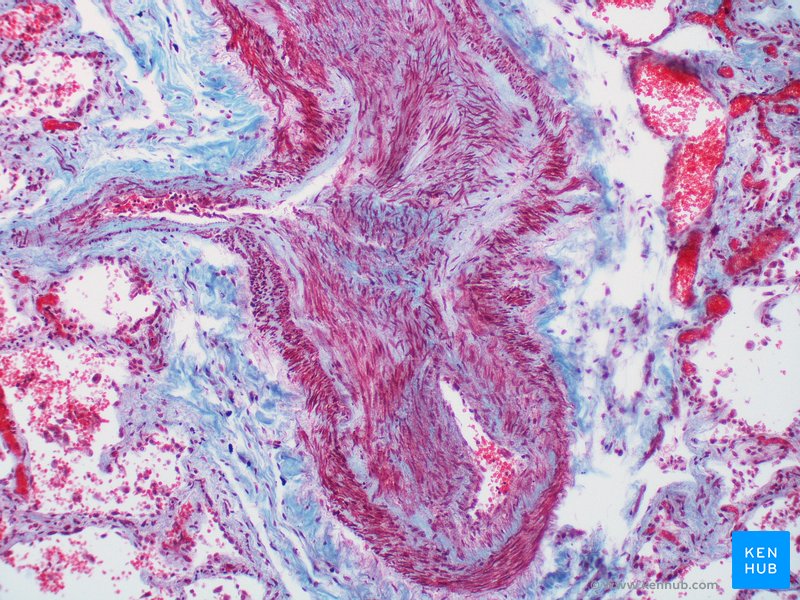 Masson's Trichrome stain (Pulmonary hypertensive arteriopathy) - histological slide