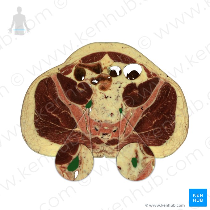 Vena iliaca interna (Innere Beckenvene); Bild: National Library of Medicine