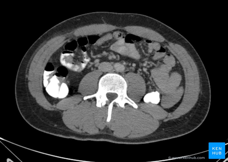 Male abdomen pelvis - CT