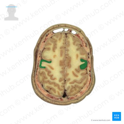 Precentral gyrus (Gyrus precentralis); Image: National Library of Medicine