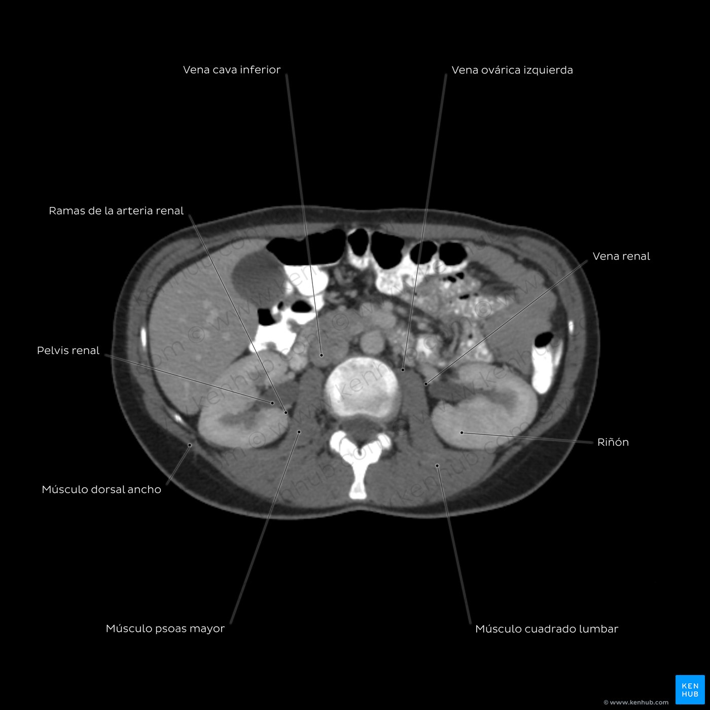 TC de los órganos urinarios y reproductores femeninos a nivel de L3