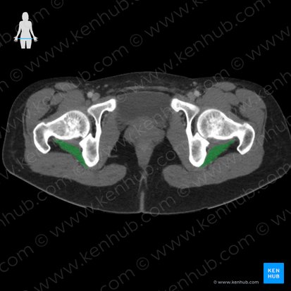 Inferior gemellus muscle (Musculus gemellus inferior); Image: 