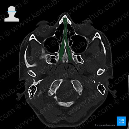 Meato nasal común (Meatus nasalis communis); Imagen: 