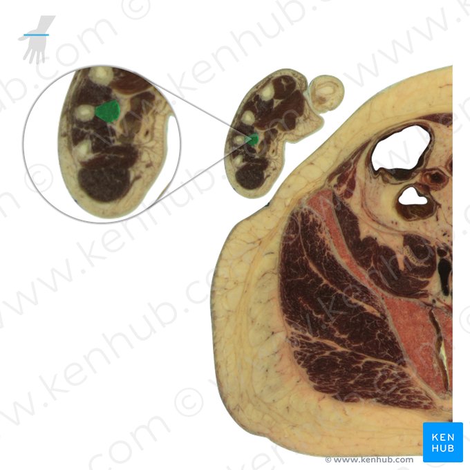 2nd palmar interosseous muscle (Musculus interosseus palmaris 2); Image: National Library of Medicine