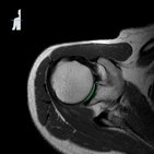 Normal shoulder MRI