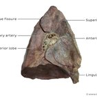 Clinical case: Postpneumonectomy syndrome