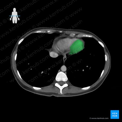 Ventriculus sinister cordis (Linke Herzkammer); Bild: 