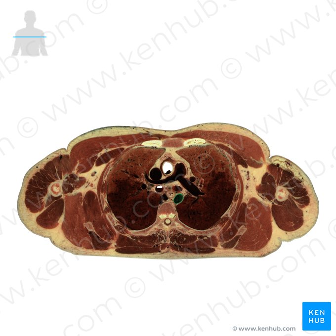 Descending thoracic aorta (Aorta thoracica descendens); Image: National Library of Medicine