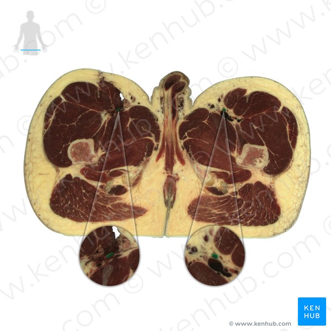 Femoral artery (Arteria femoralis); Image: National Library of Medicine