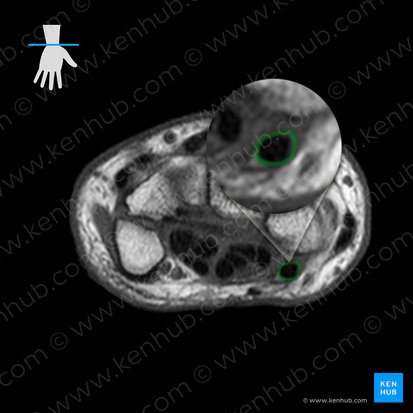 Vagina tendinis musculi flexoris carpi radialis (Sehnenscheide des speichenseitigen Handbeugers); Bild: 