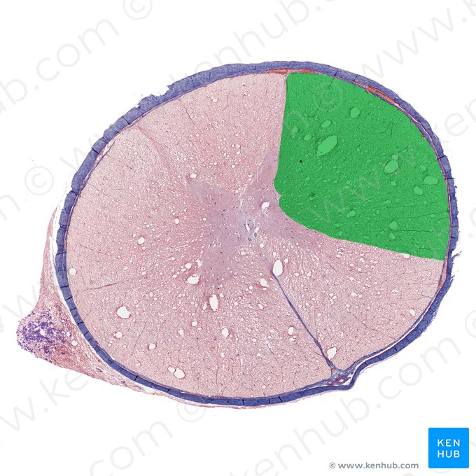 Funículo lateral da medula espinal (Funiculus lateralis medullae spinalis); Imagem: 