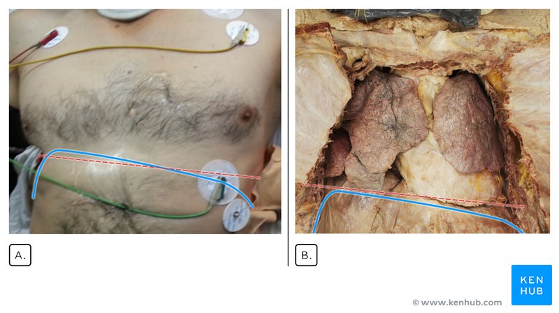 Comparison of the patient preoperatively and cadaveric dissection of the same area