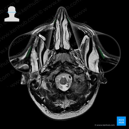 Nasalis muscle (Musculus nasalis); Image: 