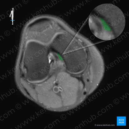 Posterior cruciate ligament (Ligamentum cruciatum posterius); Image: 