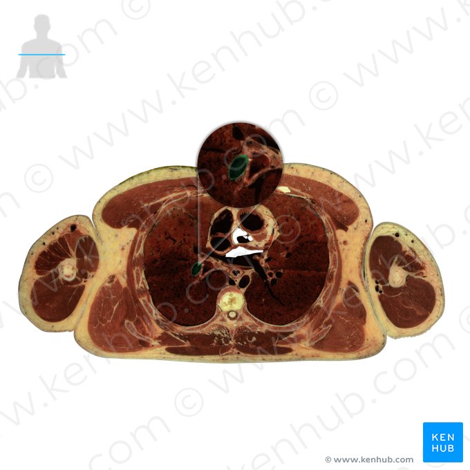 Right pulmonary artery (Arteria pulmonalis dextra); Image: National Library of Medicine