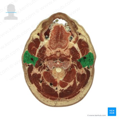 Parotid gland (Glandula parotidea); Image: National Library of Medicine