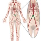 Iliac arteries