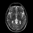 Resonancia magnética cerebral normal