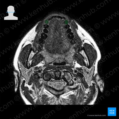 Canine tooth (Dens caninus); Image: 