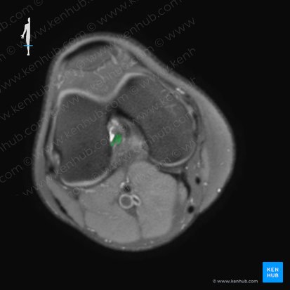 Ligamentum cruciatum anterius (Vorderes Kreuzband); Bild: 