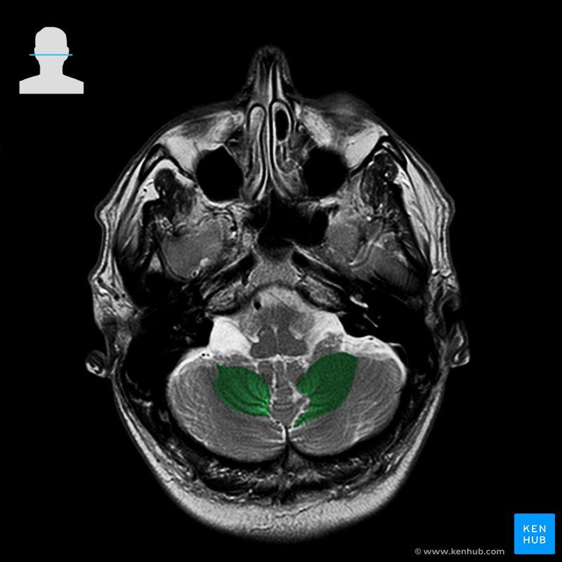 Biventral lobule of the cerebellum