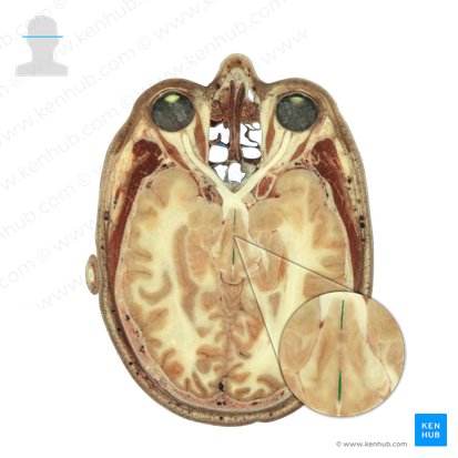 Third ventricle (Ventriculus tertius); Image: National Library of Medicine