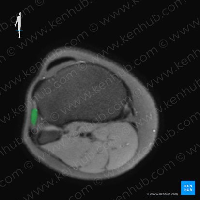 Musculus fibularis longus (Langer Wadenbeinmuskel); Bild: 