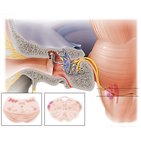 Vestibulocochlear nerve