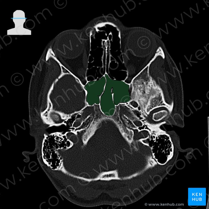 Seio esfenoidal (Sinus sphenoidalis); Imagem: 