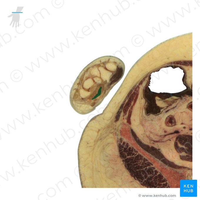 Tendons of flexor digitorum superficialis muscle (Tendines musculi flexoris digitorum superficialis); Image: National Library of Medicine