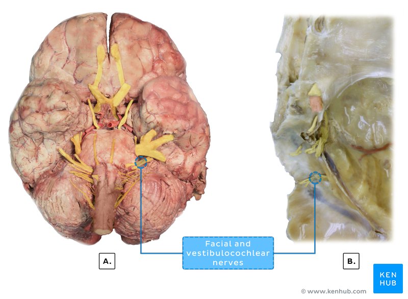 Vestibulocochlear nerve (cadaver)