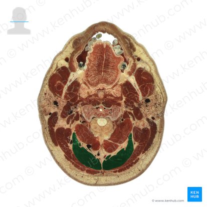 Semispinalis capitis muscle (Musculus semispinalis capitis); Image: National Library of Medicine