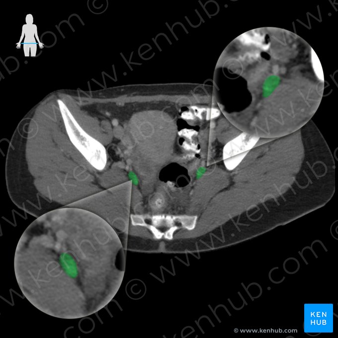 Internal iliac vein (Vena iliaca interna); Image: 