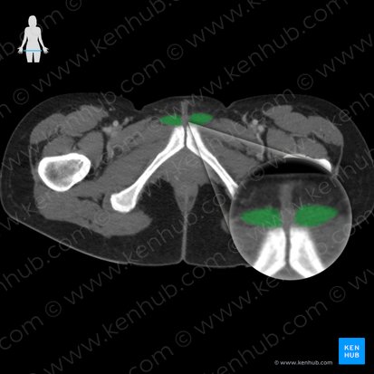 Musculus adductor longus (Langer Oberschenkelanzieher); Bild: 