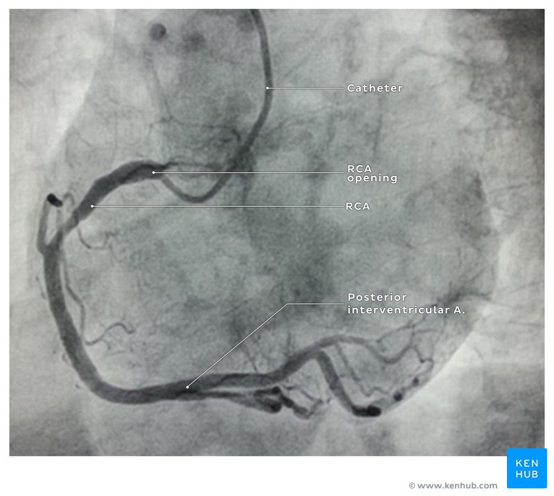 Right coronary artery angiography