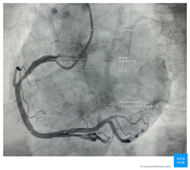 Right coronary artery angiography