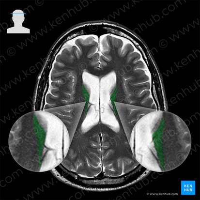 Corpus nuclei caudati (Körper des Schweifkerns); Bild: 