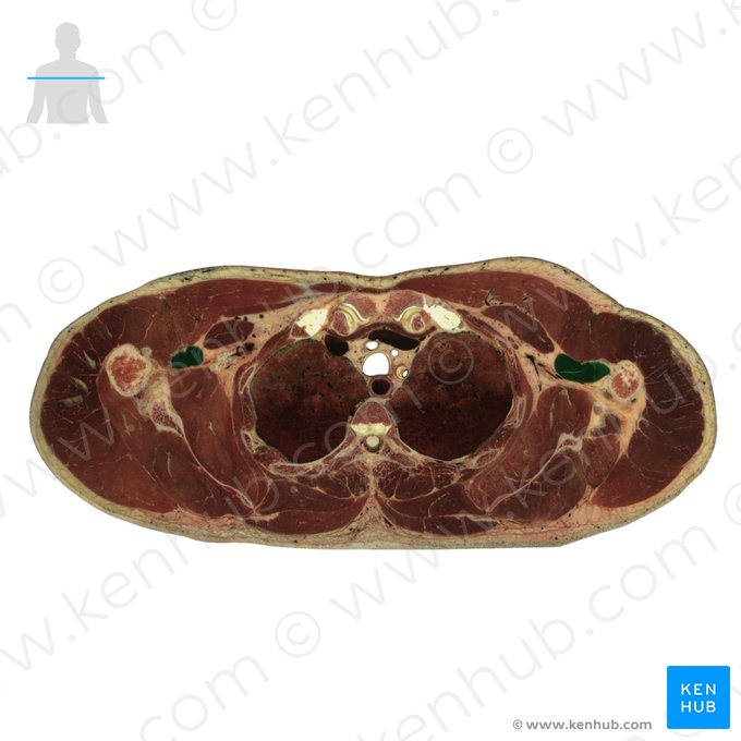 Musculus coracobrachialis (Rabenschnabel-Oberarmmuskel); Bild: National Library of Medicine