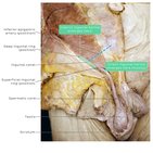 Clinical case: Giant inguinal hernia