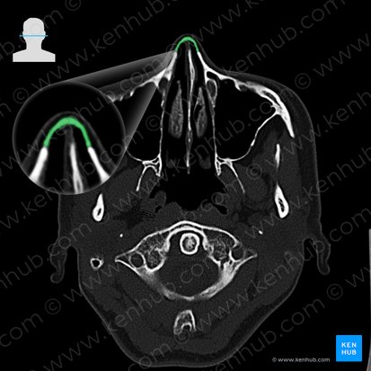 Hueso nasal (Os nasale); Imagen: 