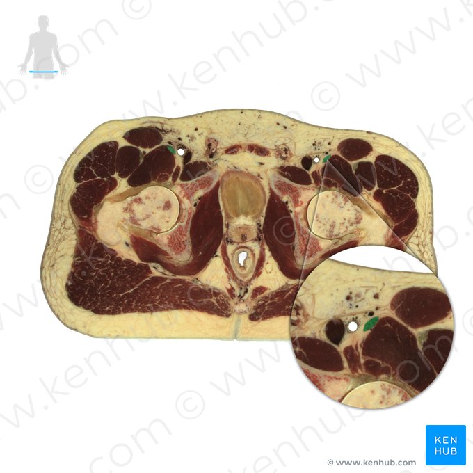 Nervo femoral (Nervus femoralis); Imagem: National Library of Medicine