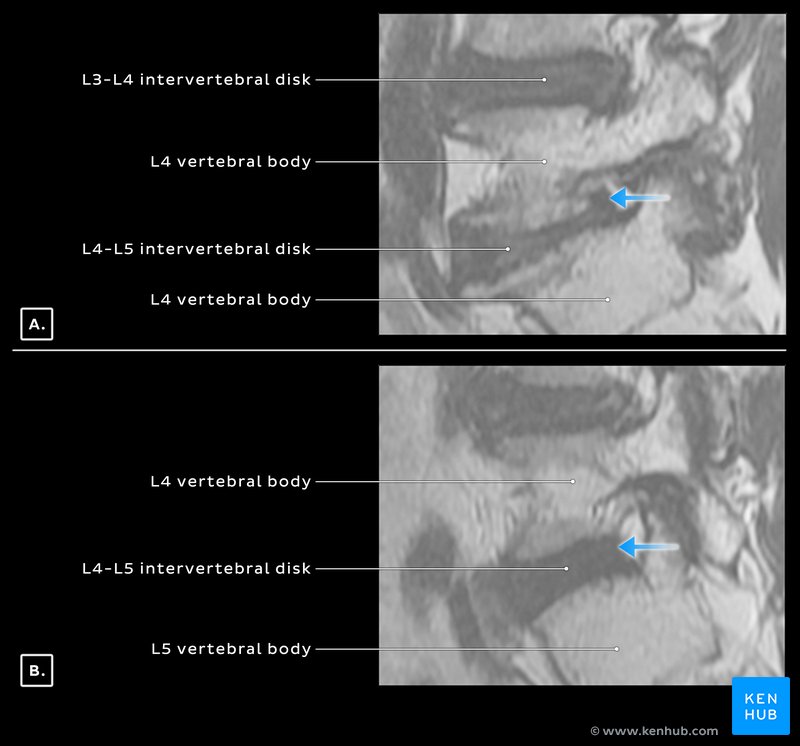 Oblique MRI