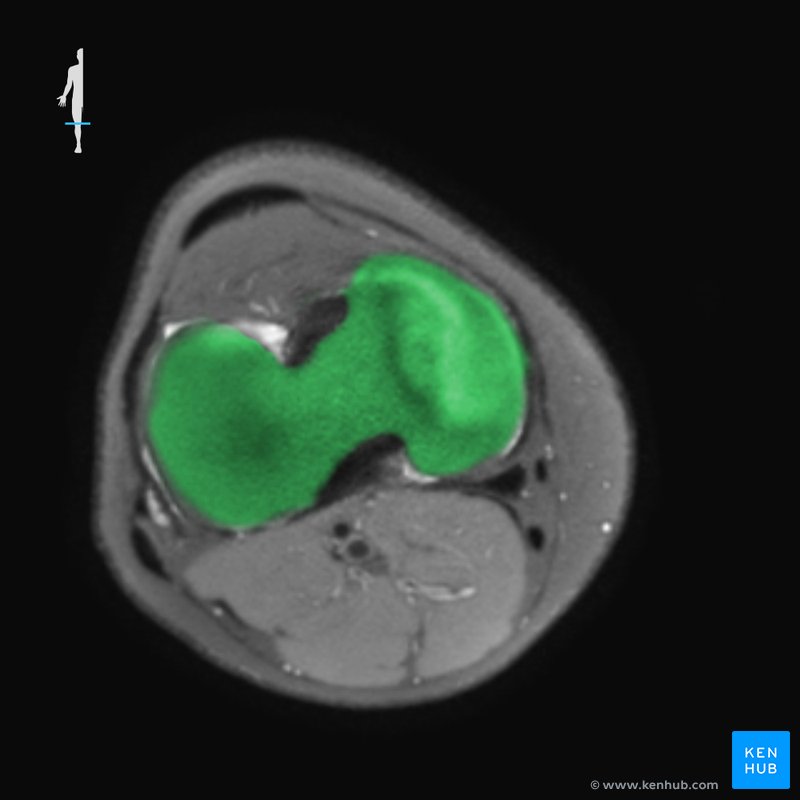 Proximale Tibia - Querschnitt - MRT