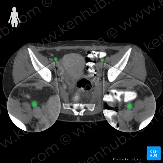 External iliac artery (Arteria iliaca externa); Image: 