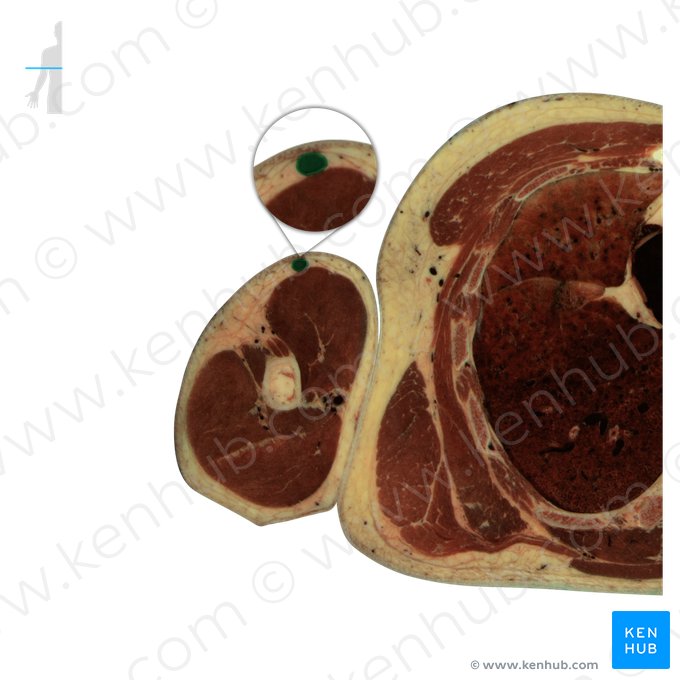 Veia cefálica (Vena cephalica); Imagem: National Library of Medicine