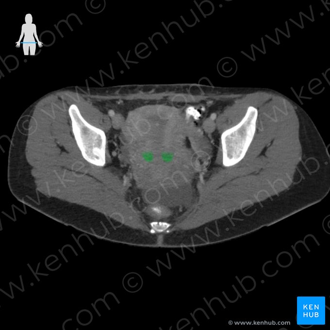 Isthmus of uterus (Isthmus uteri); Image: 