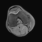 Normal knee MRI